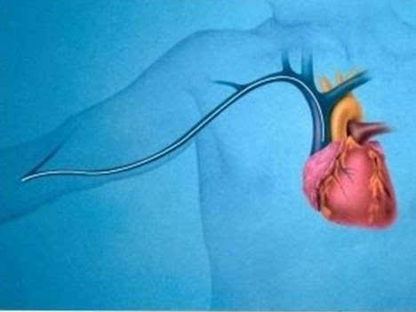 picc置管维护与安全管理